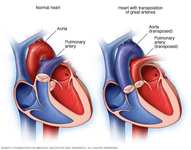 Transposition of the great arteries