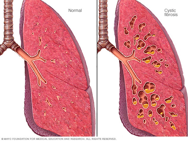 Normal airway versus airway with cystic fibrosis