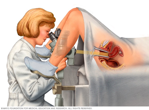 Colposcopy 