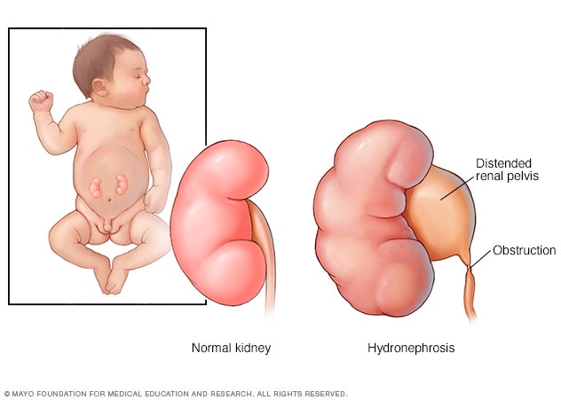 Typical kidney and a kidney with hydronephrosis in an infant