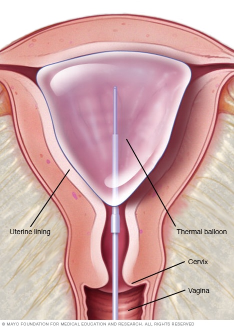 Balloon ablation