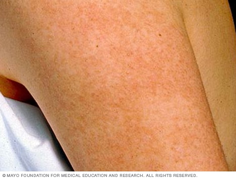 Keratosis pilaris on an arm