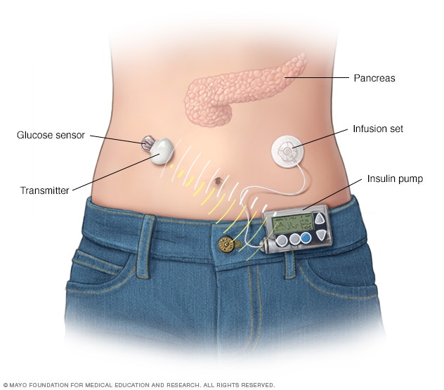 Continuous glucose monitor and insulin pump