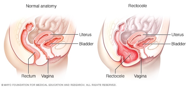 Typical anatomy and posterior vaginal prolapse (rectocele)