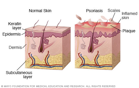 How psoriasis develops