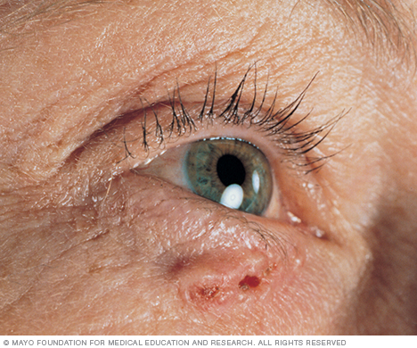 Basal cell carcinoma on white skin