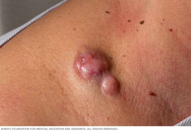 Dermatofibrosarcoma protuberans