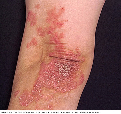 Plaque psoriasis