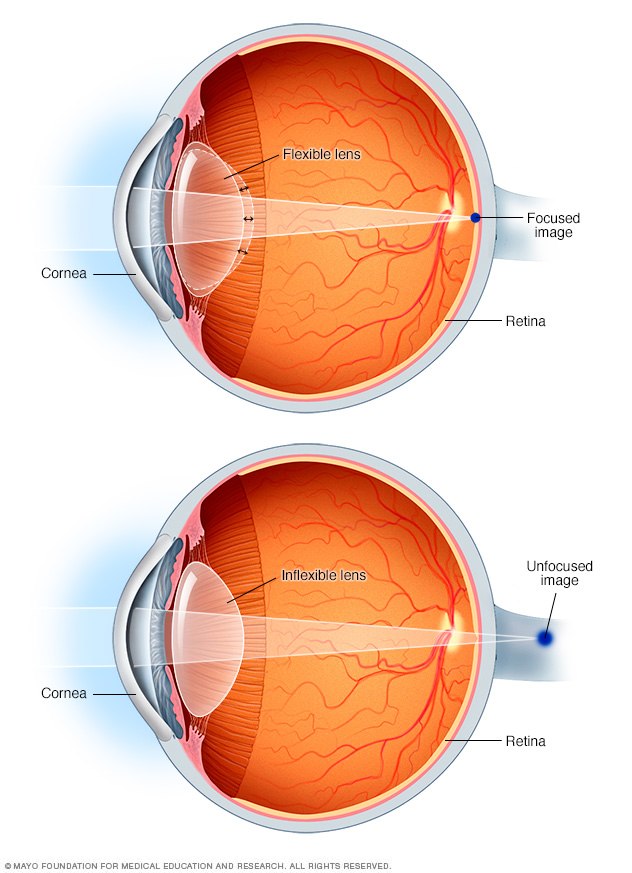 Eyeballs with point of focus without presbyopia (top) and with presbyopia (bottom)