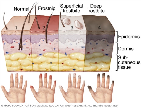 Stages of frostbite