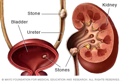 Illustration showing kidney stones 
