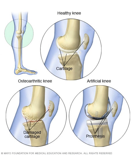 Knee, before and after knee replacement surgery