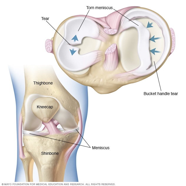 Torn meniscus