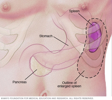 Enlarged spleen