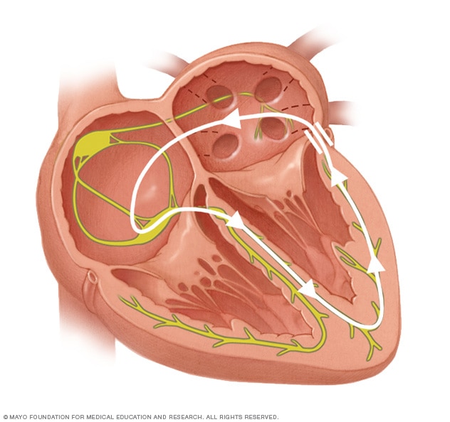 Wolff-Parkinson-White (WPW) syndrome