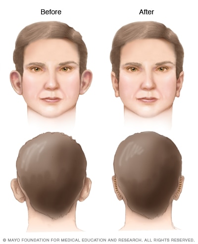 Otoplasty results