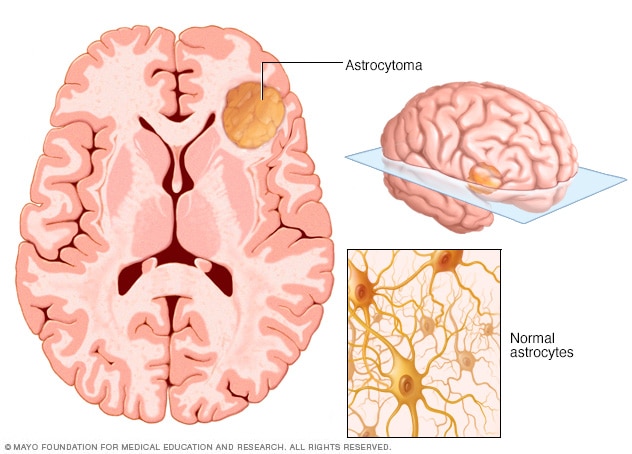 A brain with an astrocytoma brain tumor and normal astrocyte cells