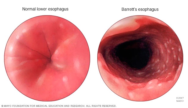 Endoscopy view of Barrett