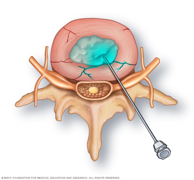 Dye injection into a spinal disk 