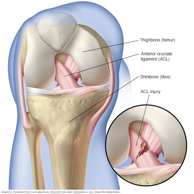 Anterior cruciate ligament