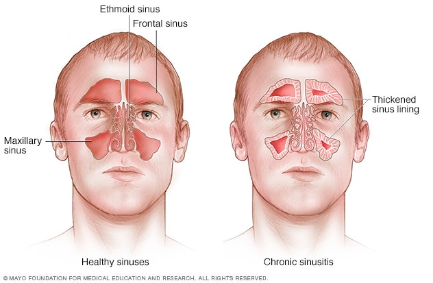 Acute sinusitis