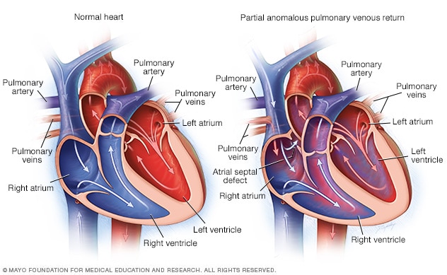 Partial anomalous pulmonary venous return