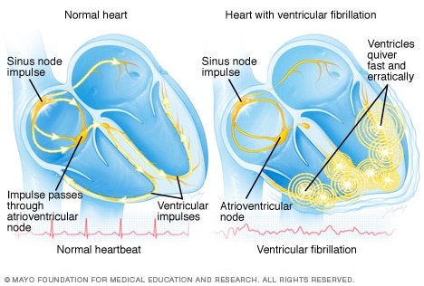 Ventricular fibrillation 