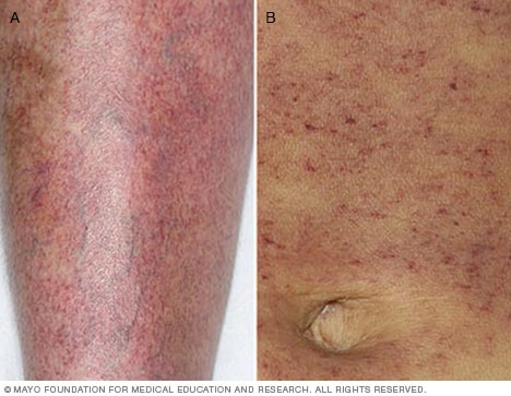 Petechiae on leg and abdomen