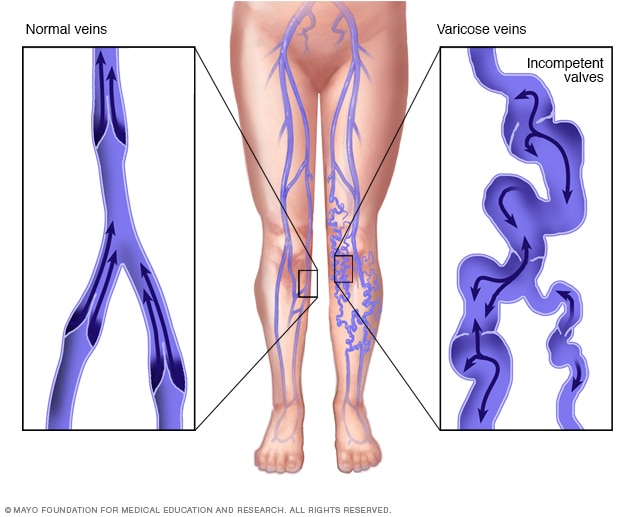 Varicose veins 