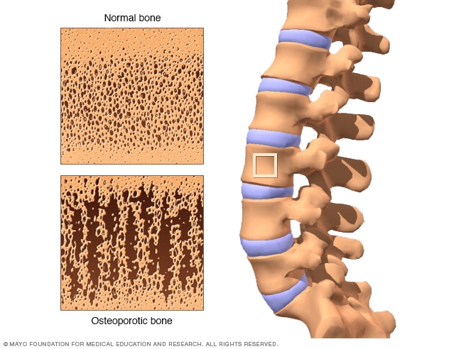 Normal bone and weakened bone