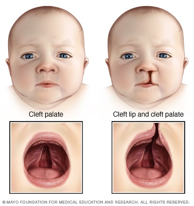 Cleft palate